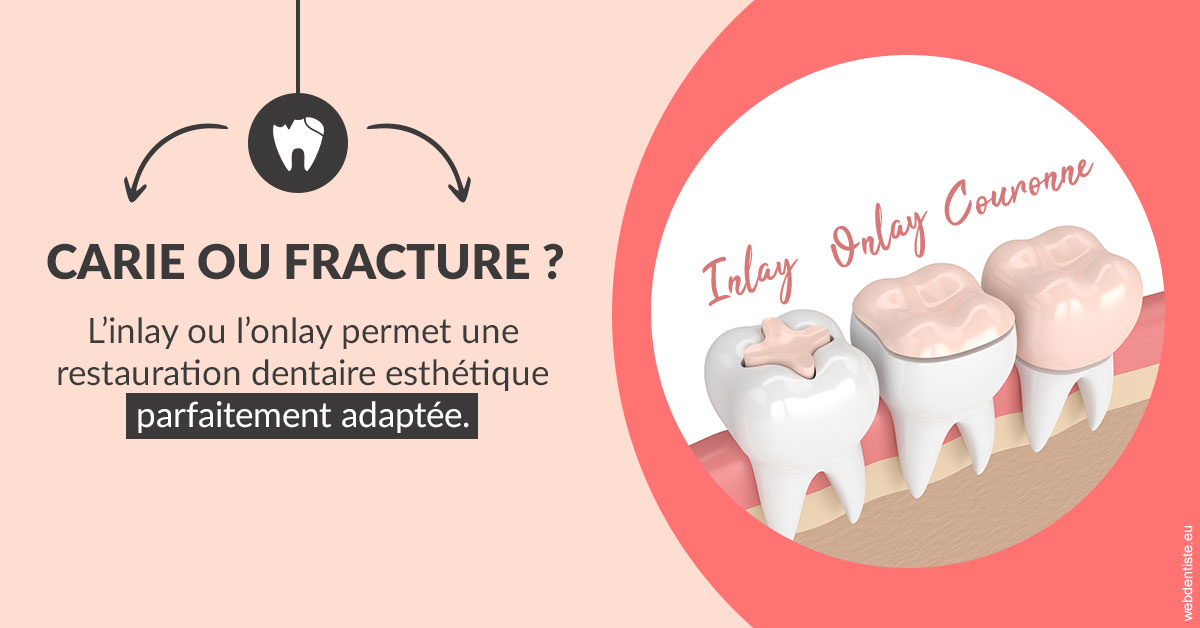 https://www.cabinetdentairedustade.fr/T2 2023 - Carie ou fracture 2
