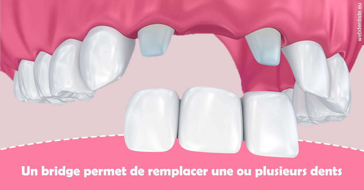 https://www.cabinetdentairedustade.fr/Bridge remplacer dents 2