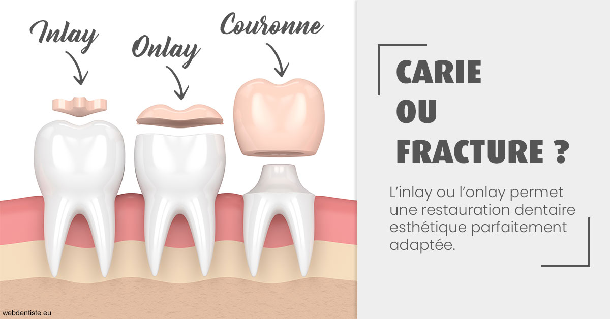 https://www.cabinetdentairedustade.fr/T2 2023 - Carie ou fracture 1