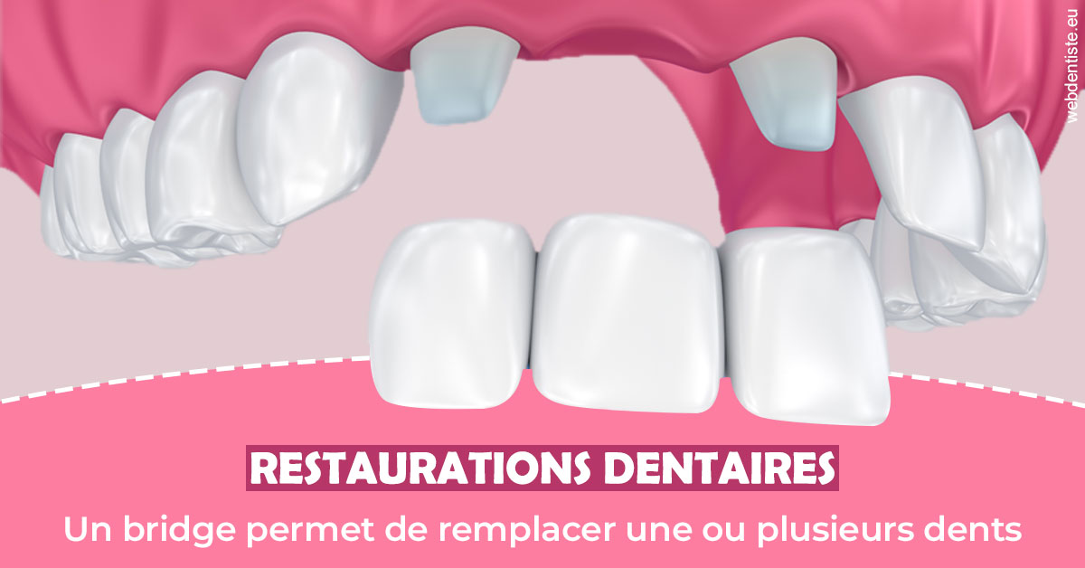 https://www.cabinetdentairedustade.fr/Bridge remplacer dents 2