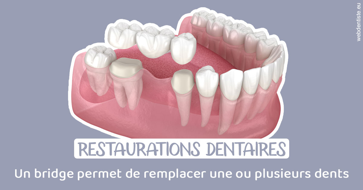 https://www.cabinetdentairedustade.fr/Bridge remplacer dents 1