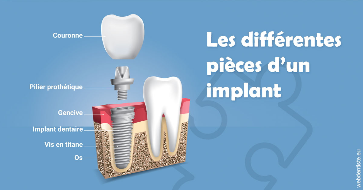https://www.cabinetdentairedustade.fr/Les différentes pièces d’un implant 1
